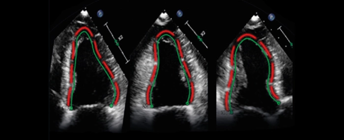 Cardiac-Ultrasound-Image-Analysis